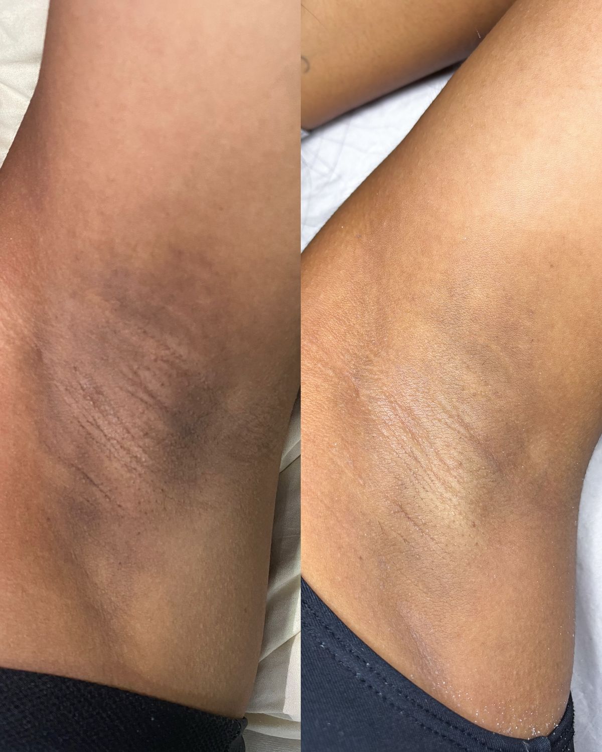 L80 Lactic Peel before treatment